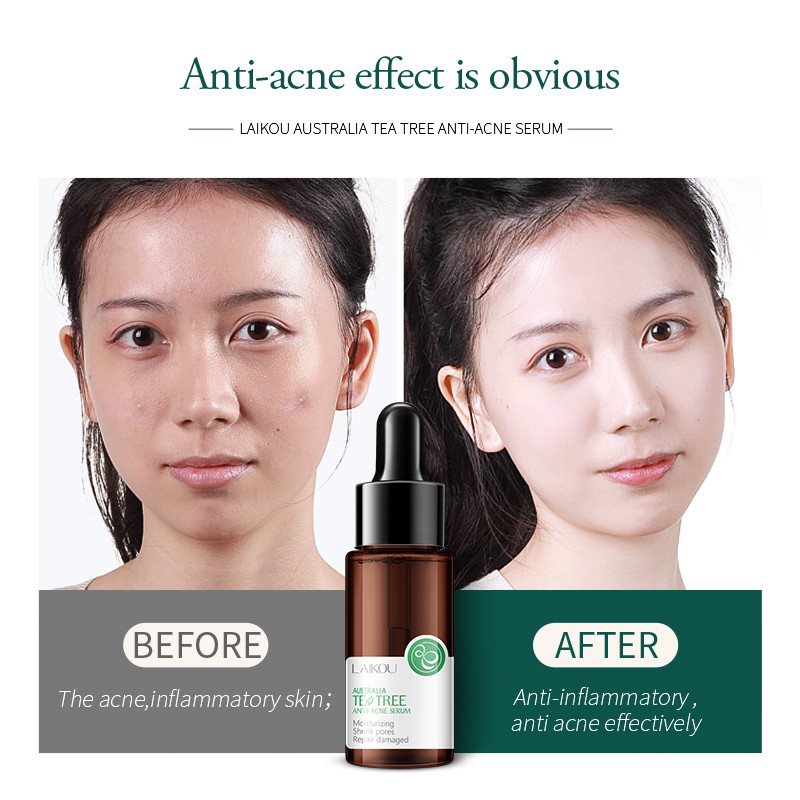 tea tree acne serum