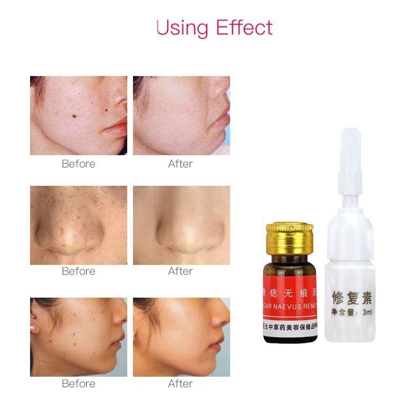 skin mole removal cream