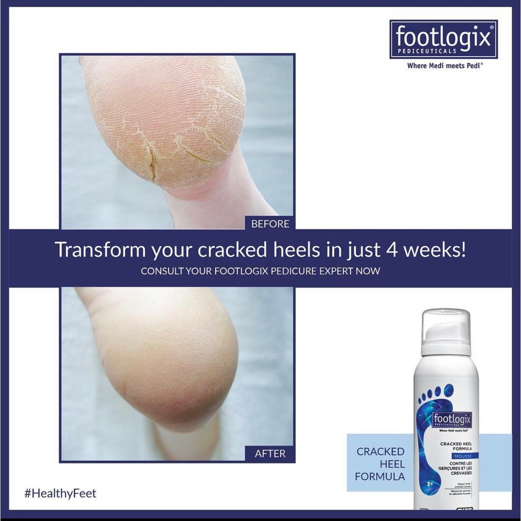 FOOTLOGIX Mousse To Restore Cracked Feet Dry Foot Cream Quick Not