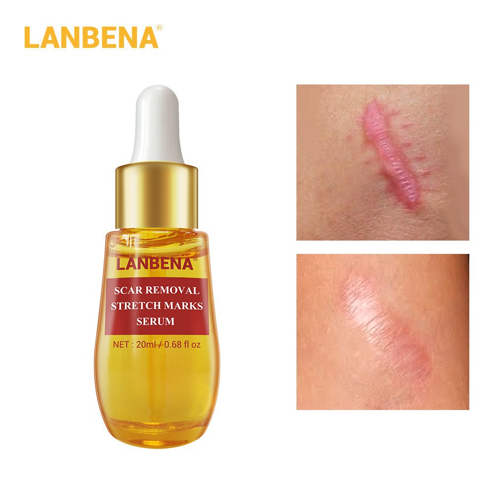 Lanbena Acne Scar Remove Serum 20ml | Shopee Philippines