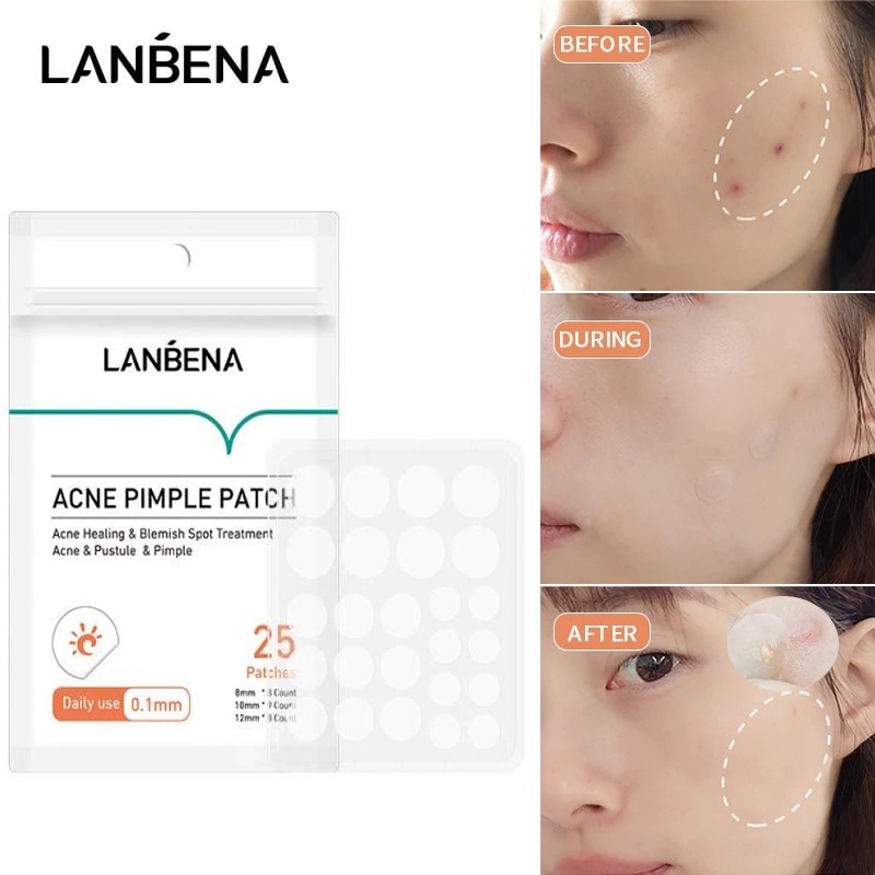 LANBENA Acne Pimple Patch Acne Treatment Stickers Blemish Face Mask