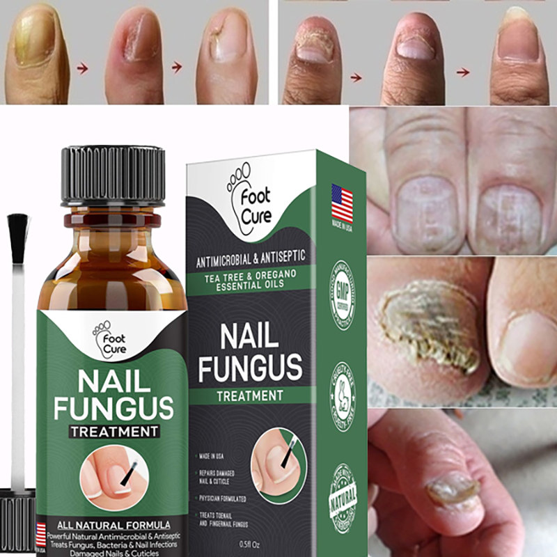 EXTRA STRONG Nail Fungus Treatment, Best Nail Repair, Fix & Renew Damaged,  Broken, Cracked & Discolored Nails | Shopee Philippines