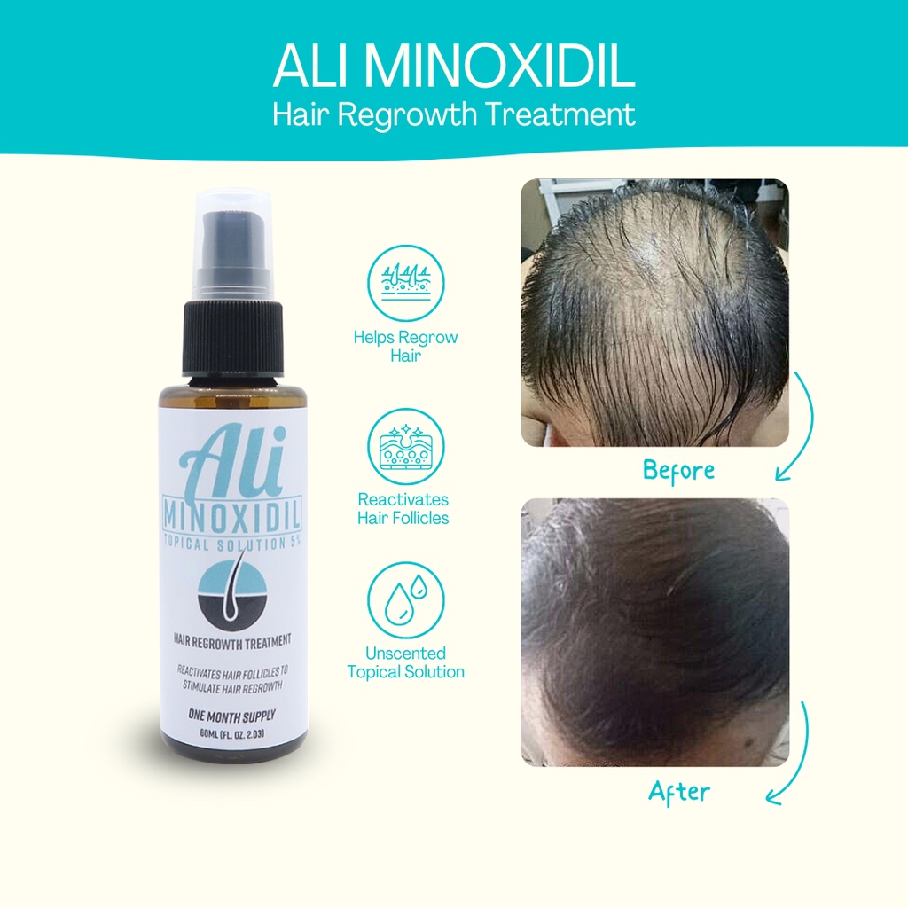 minoxidil - Best Prices and Online Promos - Jan 2023 | Shopee Philippines