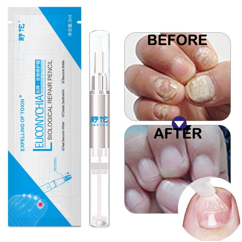 Nail Treatment Pen Onychomycosis Paronychia Anti Fungal Nail Infection