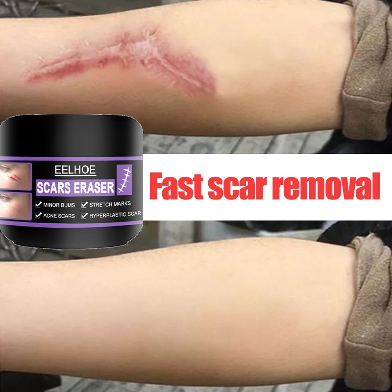 Scar Remover Scar Remover For Old Scar On Legs Acne Scar Remover All