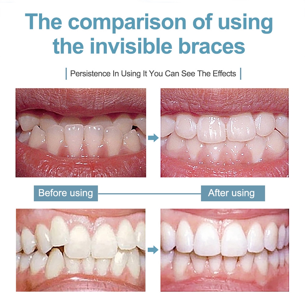 Dental Braces Orthodontic Locator Invisible Orthodontic Bracket For Smile Teeth Alignment Trainer And Dental Care With Box Shopee Philippines