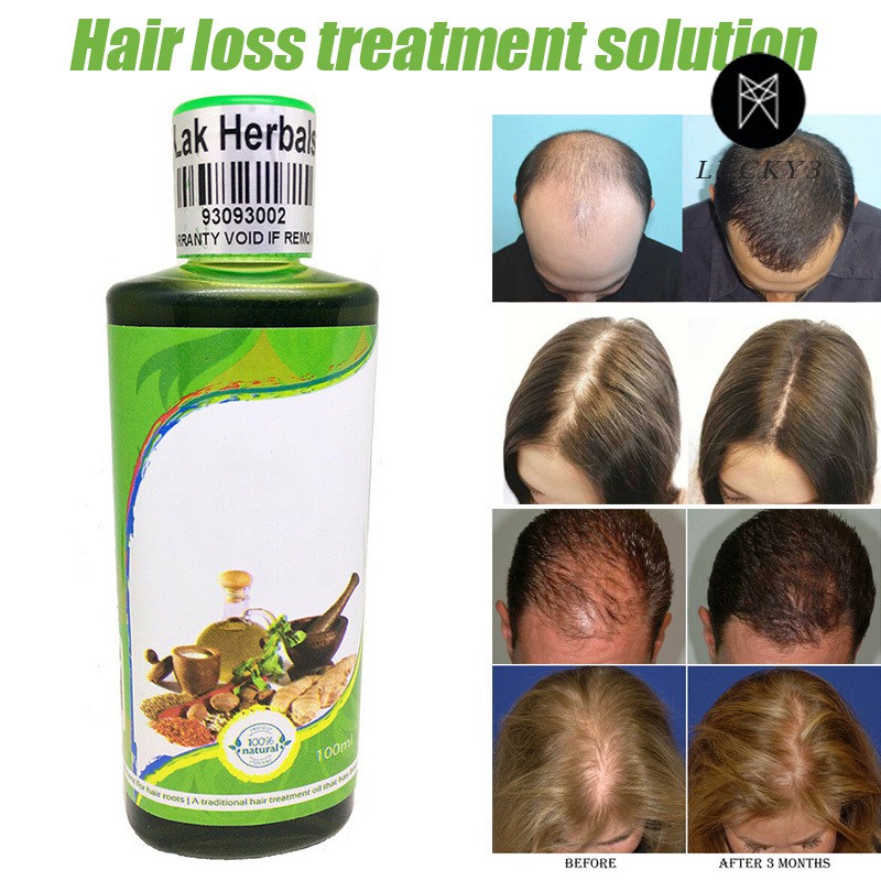 Hair Loss Treatment Regrow Liquid Care Protect From Dandruff For Women Men Shopee Philippines