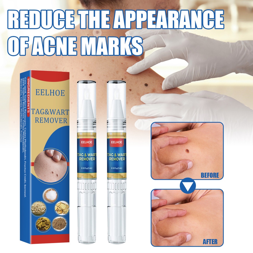 Skin Mole Removal Pen Remover Anti Verruca Remedy Liquid Pen Without Leaving Scars