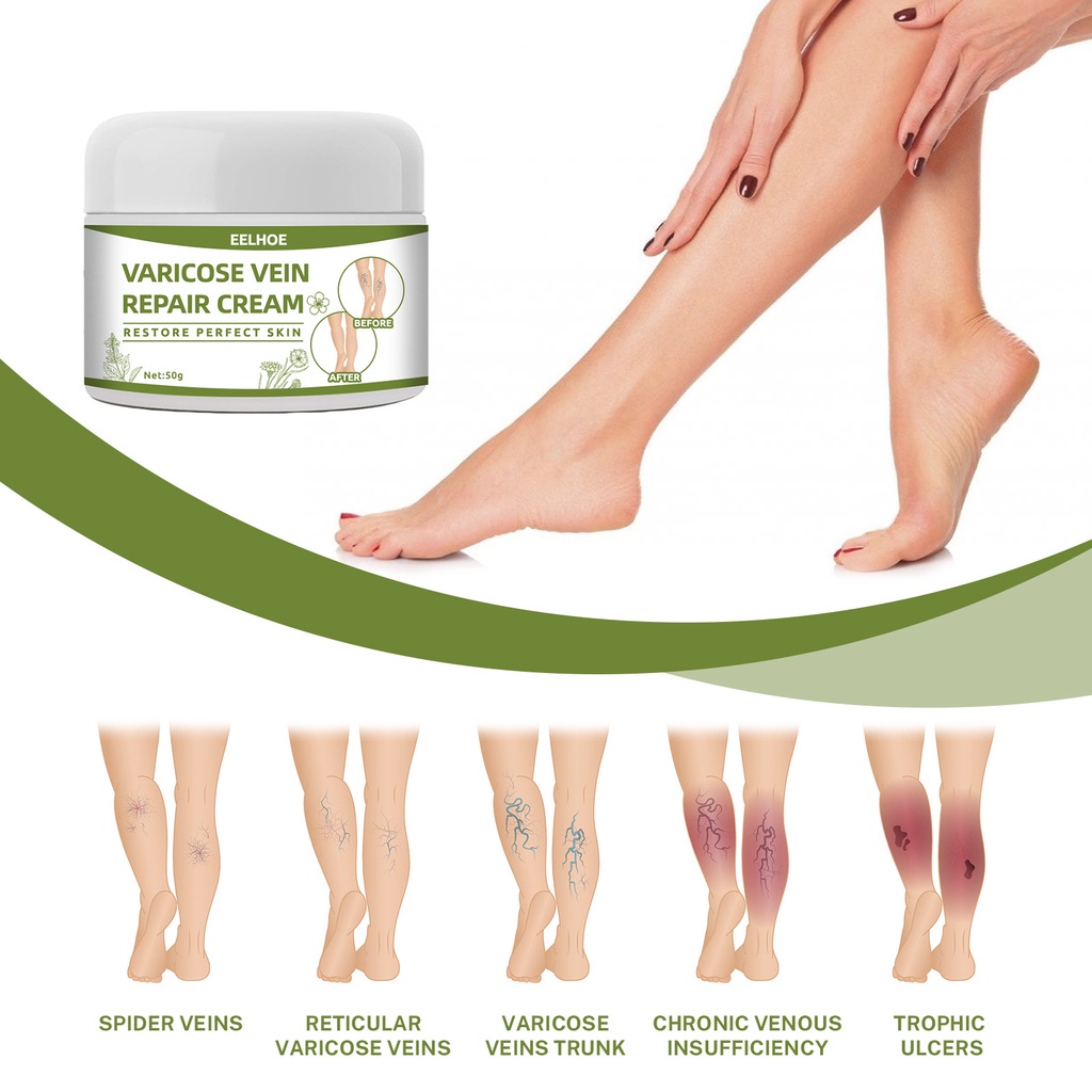 EELHOE Varicose Vein Repair Cream Tongmai Relieves Leg Varicose Vein ...