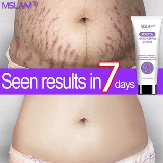 MSLAM Stretch Mark Repair Cream 50g Special for Pregnancy Postpartum Care Remove pregnancy scars