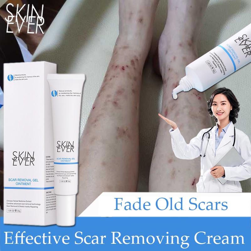 Keloid Remover Scar Removal Scar Cream Scar Treatment Gel Effective Old