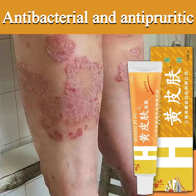 Eczema Cream Psoriasis Eczema Cream Antifungal Antibacterial Itchy