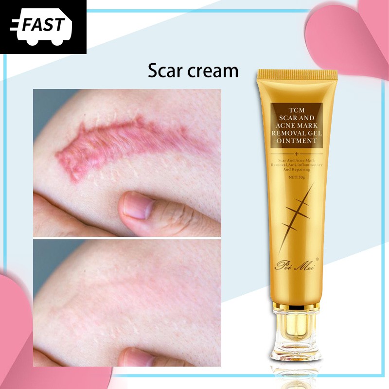stretch marks on legs removal cream