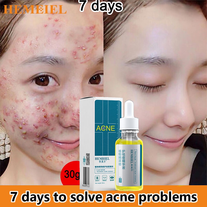 HEMEIEL Pimple Marks Acne Remover/Adapalene Clindamycin/Back Acne