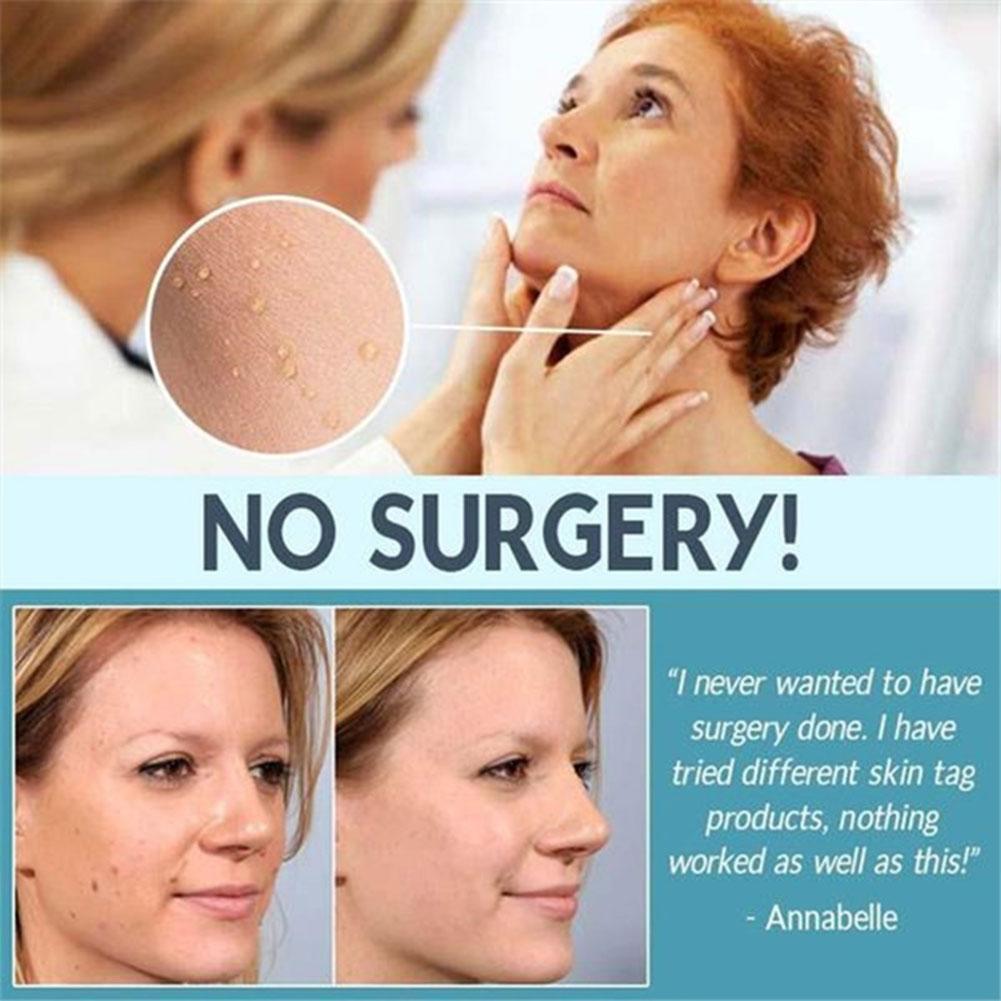 Ultra Strength Natural Health Mole Nevus Wart Skin Foot Tag Warts Tag Removal Corn Skin O3X5