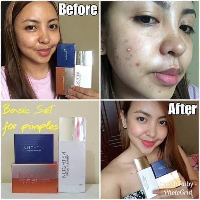 oily skin problems solutions