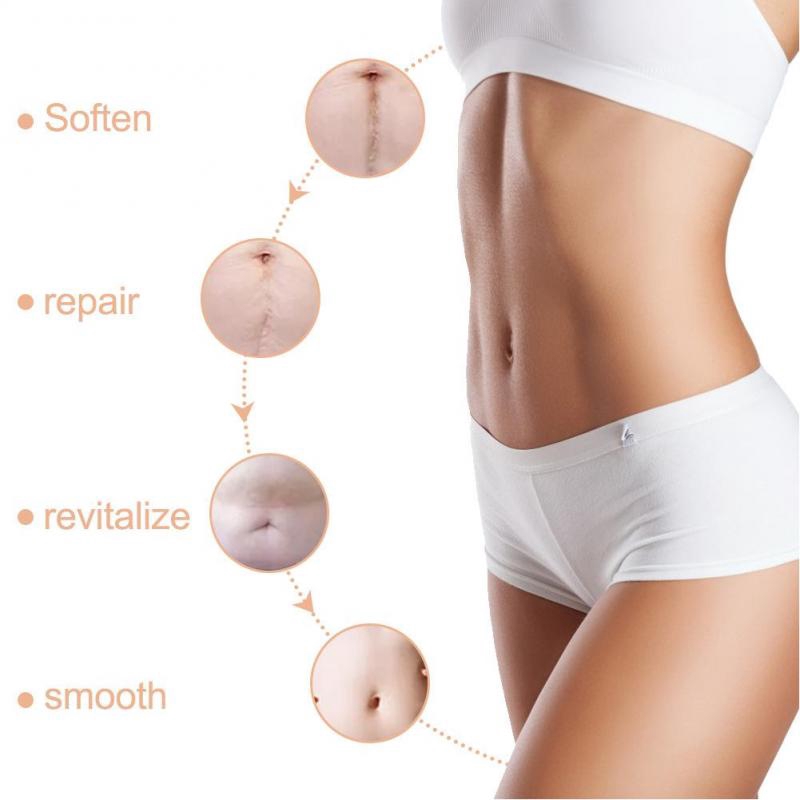 ALIVER Self-Adhesive Silicone Scar Sheet Caesarean Section Surgery Removal  Pad | Shopee Philippines