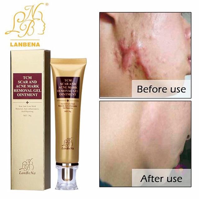 lan be na tcm scar and acne mark removal gel ointment