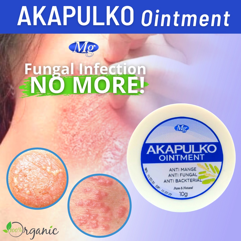 Akapulk Ointment Treat Different Skin Disease Infections treating fungal infection & insect