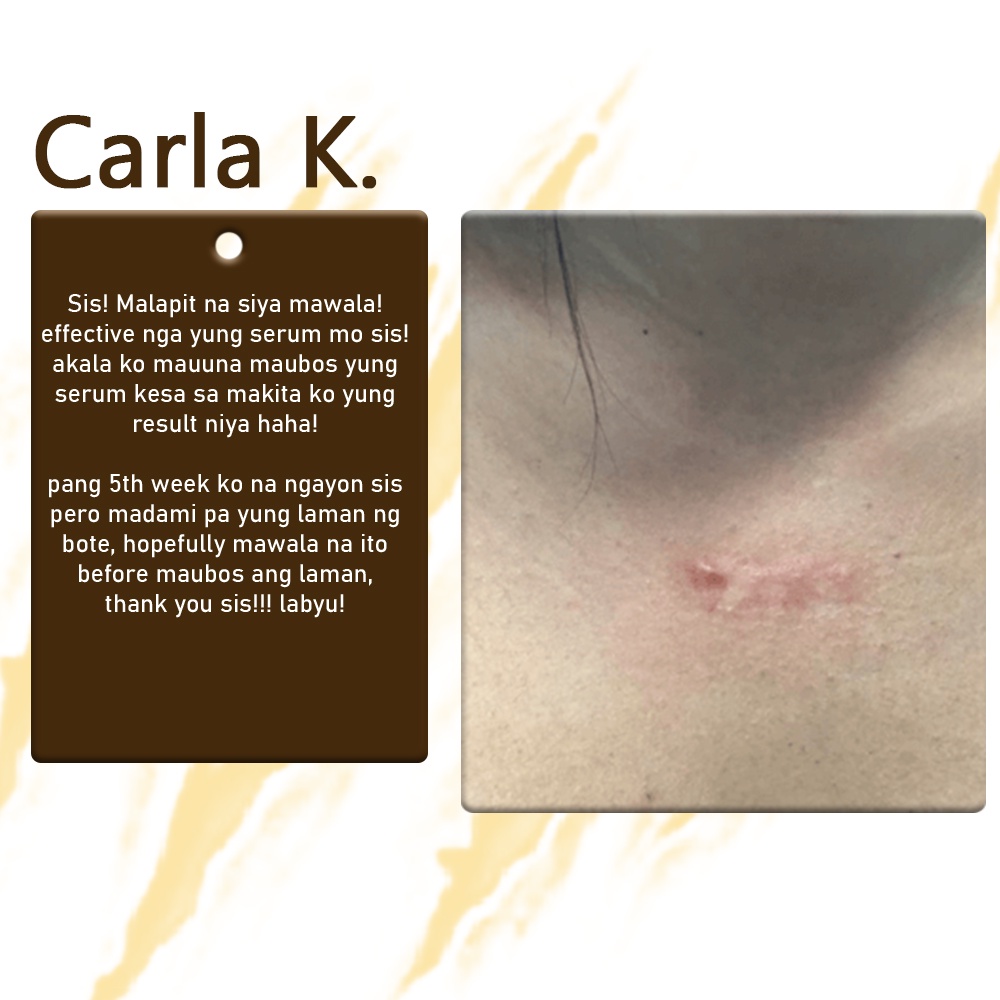 BEST SELLER DR. KELOID scar and keloid remover , keloid scar remover original , keloids removal orig #7