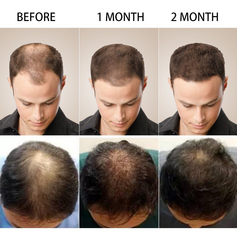 burst✽PURC Hair Growth Serum hair grower Hair Grower for Men Hair Growth  Spray Essence Anti Hair Los | Shopee Philippines