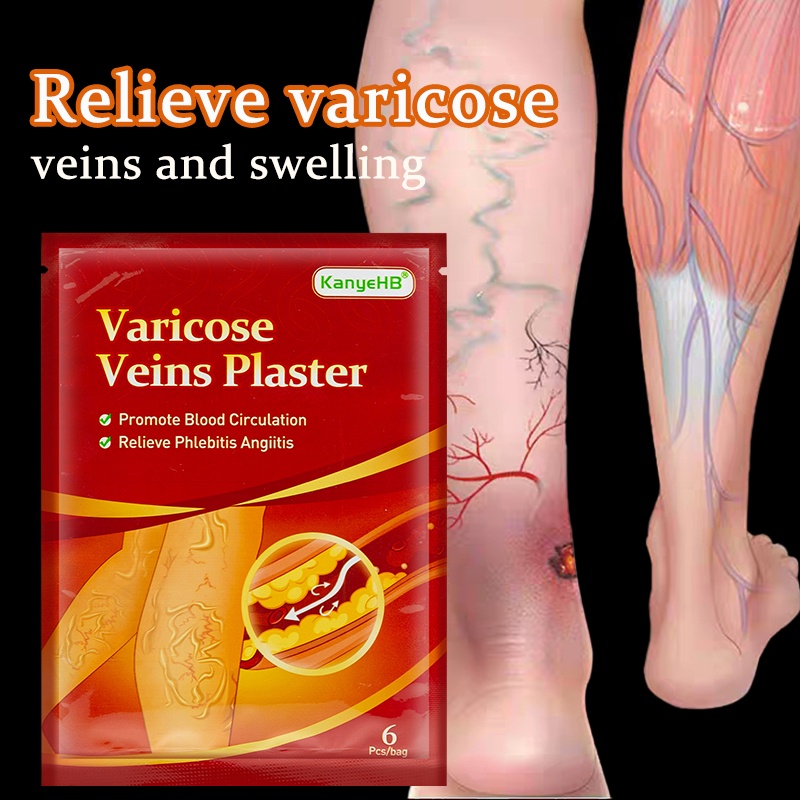 Varicose Veins Patch Varicose Veins Vasculitis Phlebitis