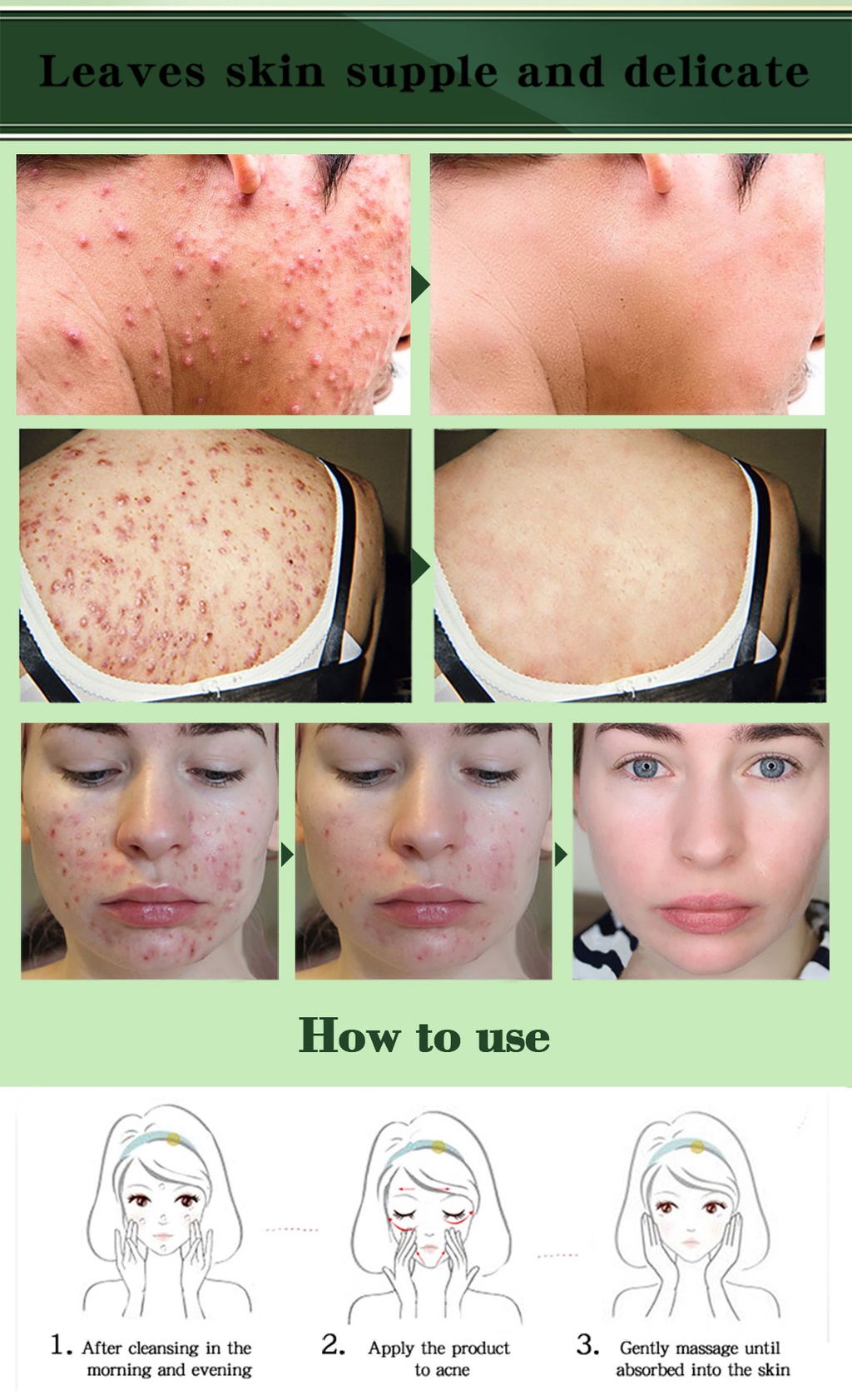 MABREM Acne Treatment Skin Care Remove Acne Oil Control Oil Shrink Pores Whitening And