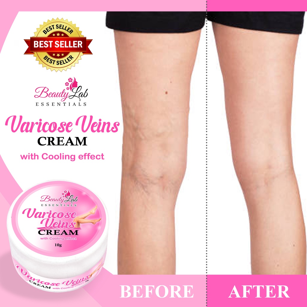 BEAUTY LAB ESSENTIALS VARICOSE VEIN CREAM 10g NATURAL HERBAL Varicose ...