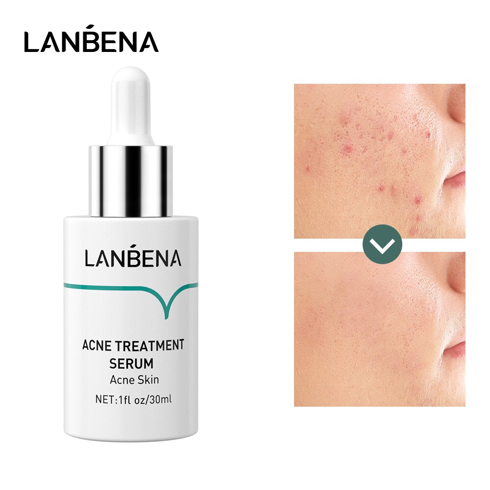 acne gone serum