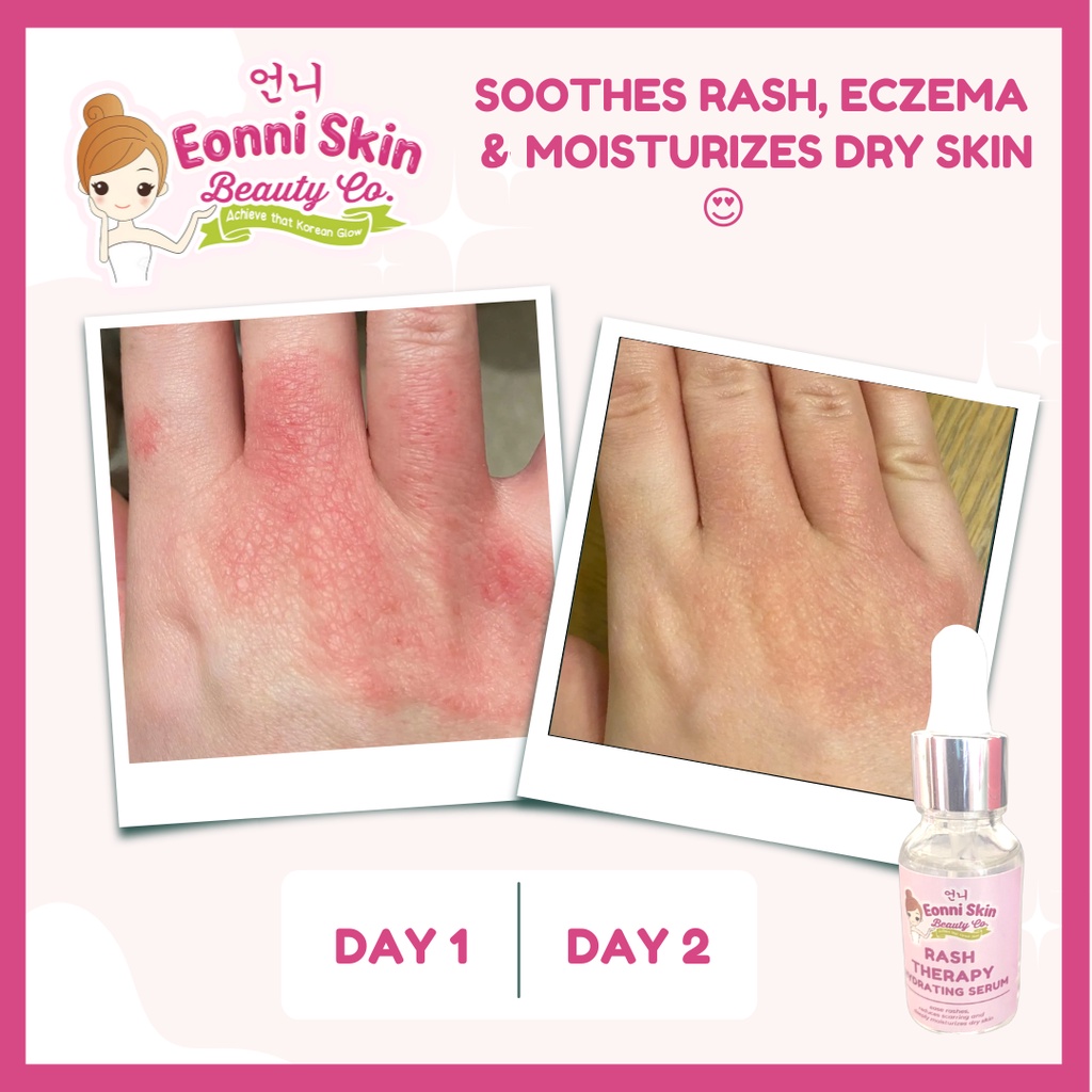 Eonni Skin Rash Therapy for Eczema and Rashes Shopee Philippines