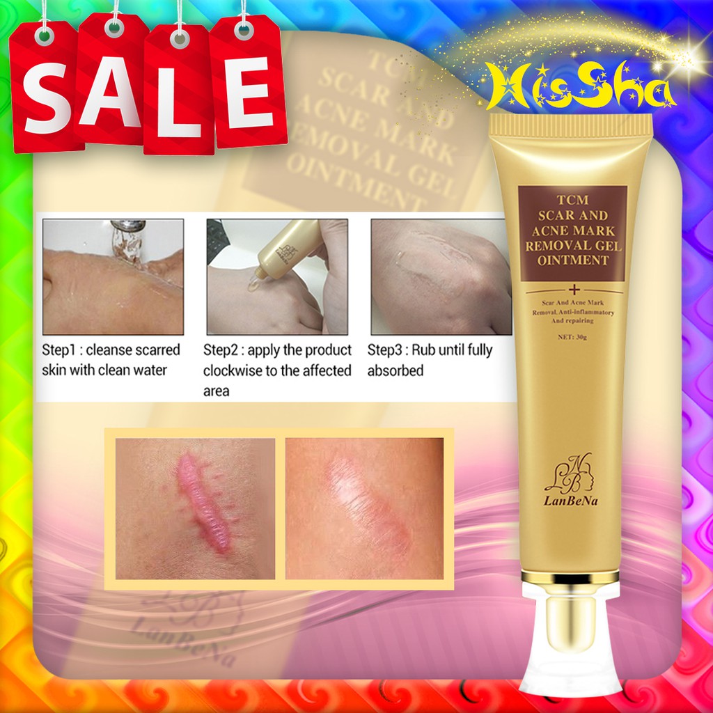 chicken pox scar removal products