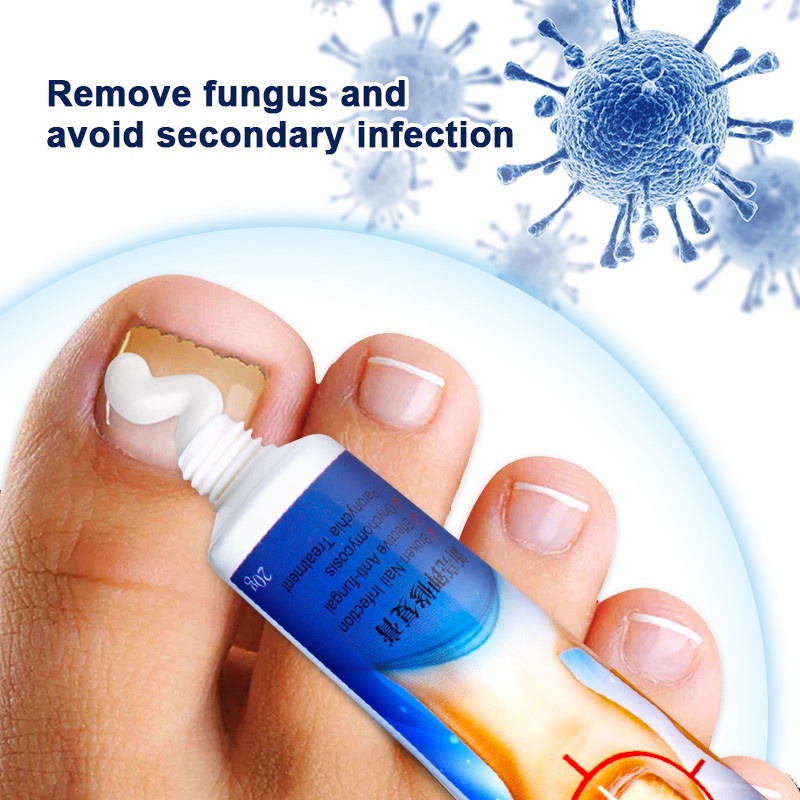 nail-fungus-removal-cream-nail-care-ointment-anti-infection-for