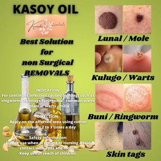 Warts Mole Remover 30ml Pure Kasoy OIL also for Butlig Kulugo Nunal An ...