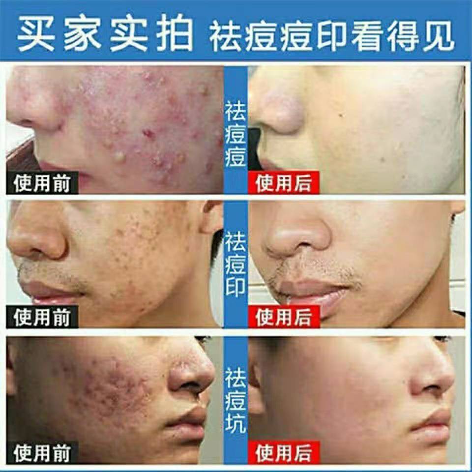 Acne removing cream acne printing pit artifact acnAcne Treatment Cream