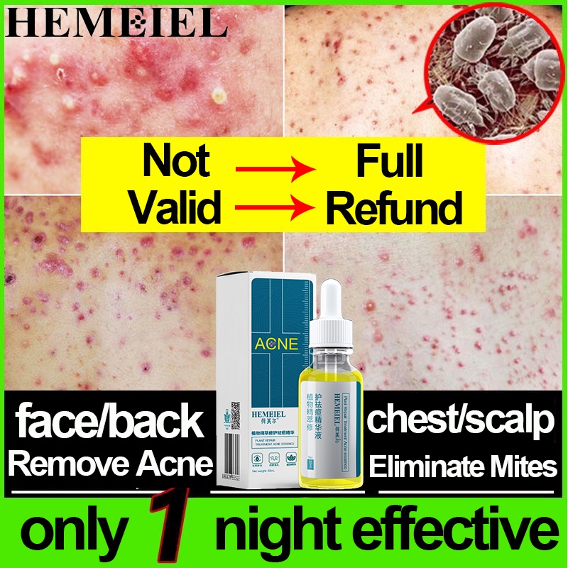 HEMEIEL Pimple Scar Remover/Oxecure Facial Acne Lotion/Quick Fx Pimple