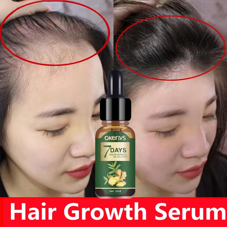 ginger Hair Growth hair Treatment Essence Ginger Essential Anti Hair Loss  Spray Hair Grower Serum | Shopee Philippines