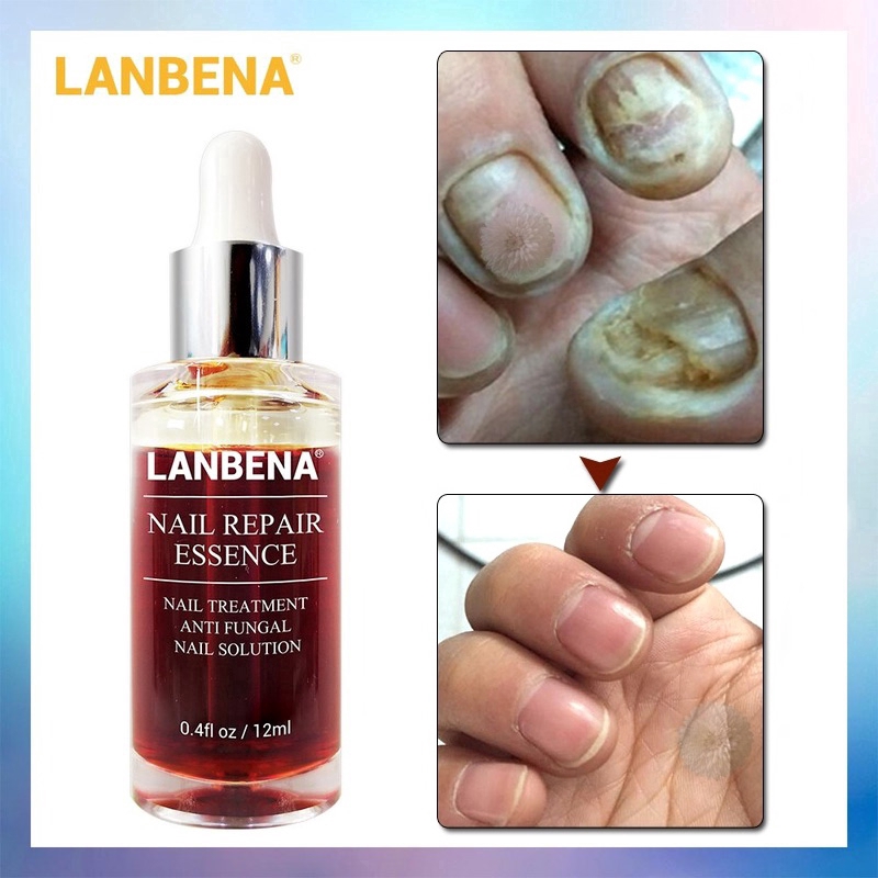 LANBENA Nail Repair Essence Serum Fungal Nail Treatment Remove