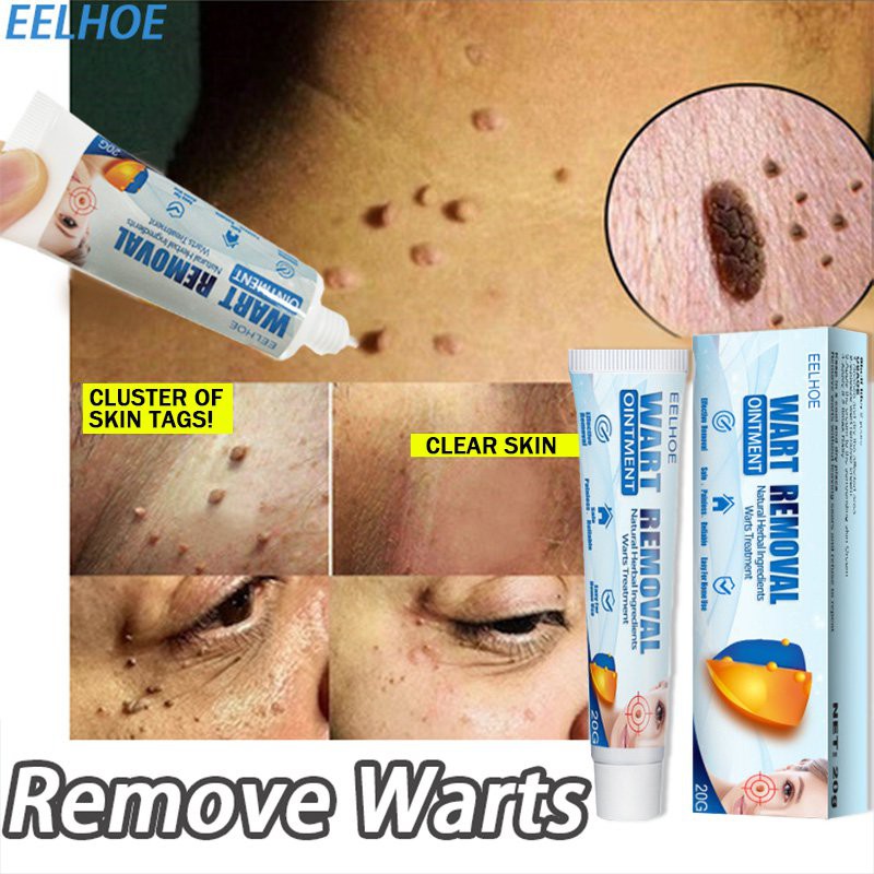 [100 effective] Warts Remover Removal Cream Wart removal cream Warts