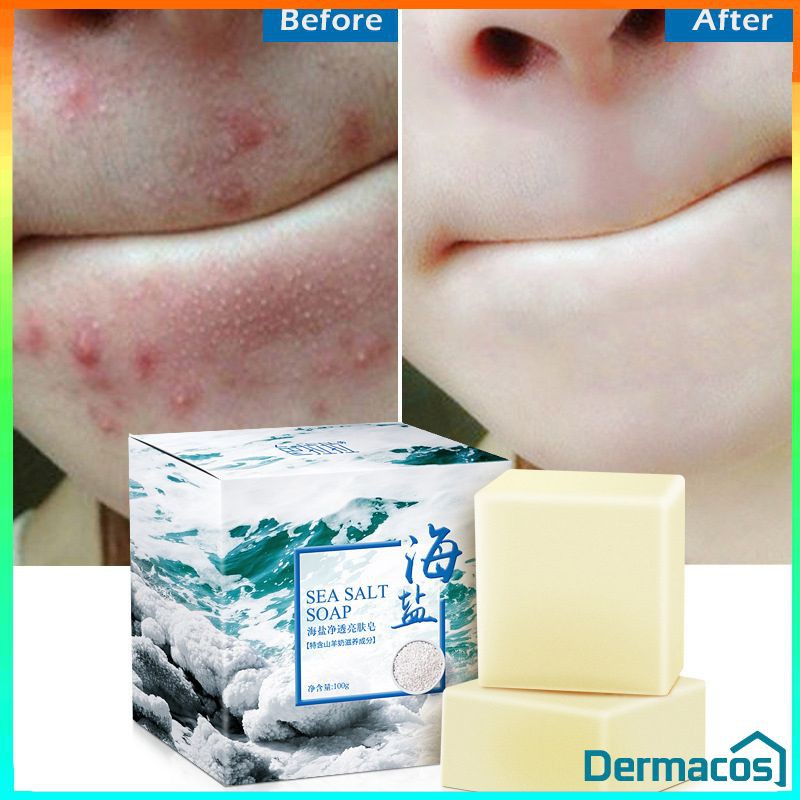 yaki soap for pimples