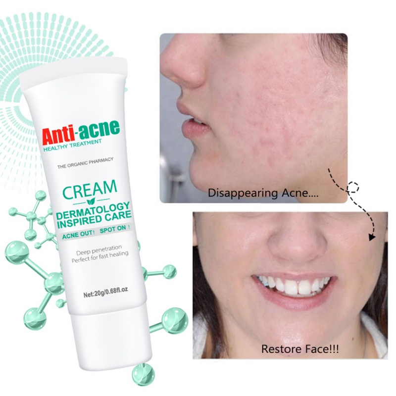 Pimple Cream Antispot Control Oil Whitening Moisturizing Skin Care
