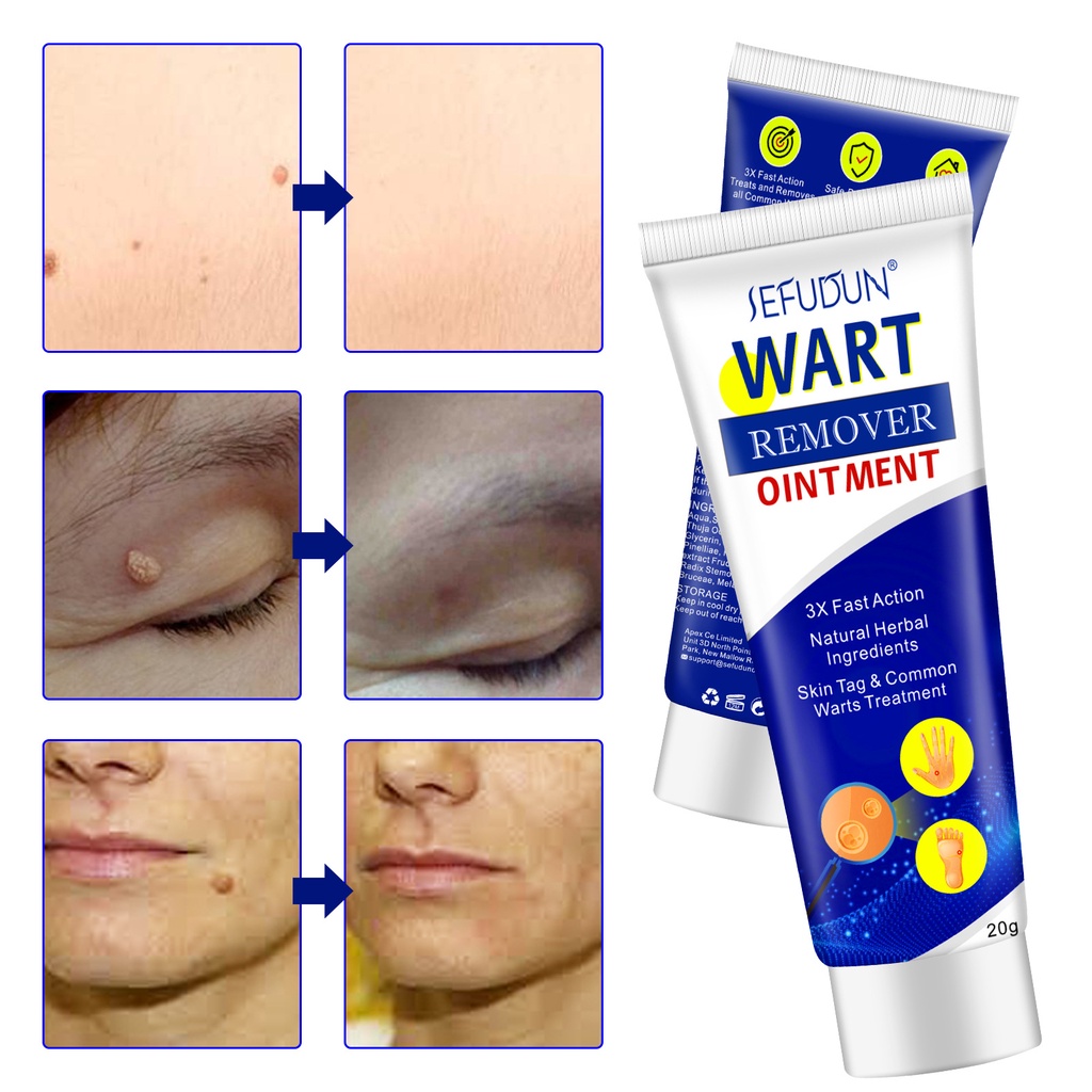 YANJIAYI SEFUDUN Painless Warts Remover Ointment Cream Effectively