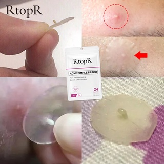 RtopR Acne Pimple Patch Invisible Acne Treatment Stickers Treatment Pimple Remover Tool Skin Care Waterproof 24 Patches Daily And Night Use #2