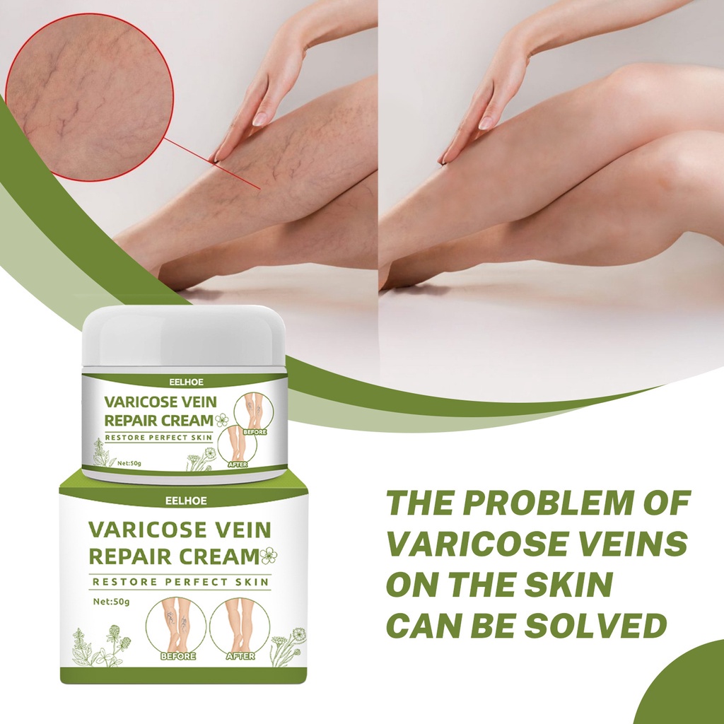 Varicose Vein Cream Ointment leg swelling care cream 50g Shopee