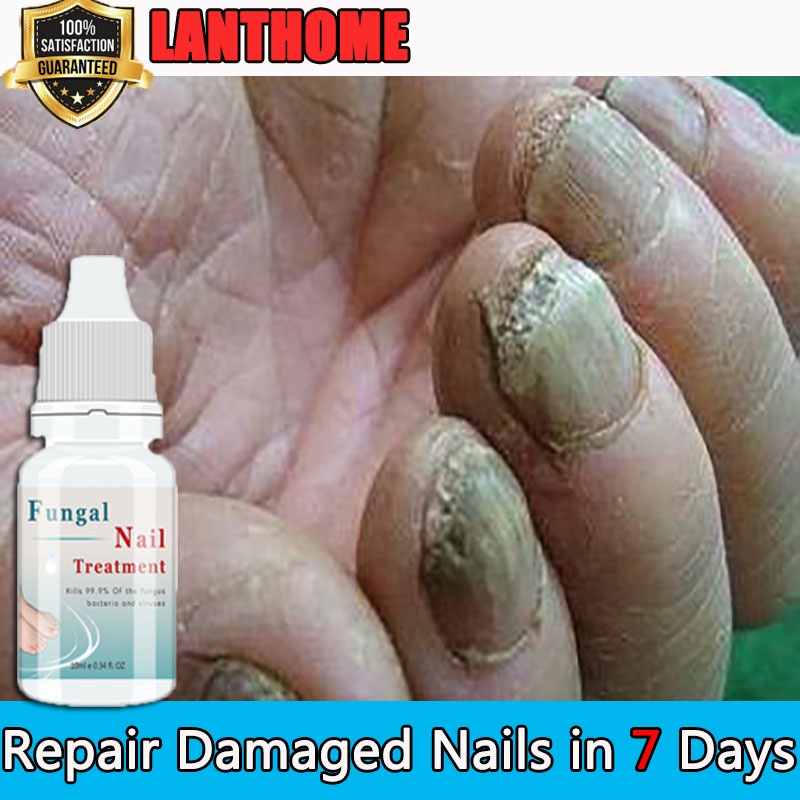 Antibacterial Nail Treatment Essential Anti Fungal Infection Infection