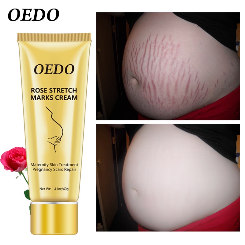 OEDO Rose Remove Stretch Marks Cream Anti Wrinkle Anti Aging Maternity Skin Repair Remove Pregnancy Scars Treatment Body Skin Care 40g #2