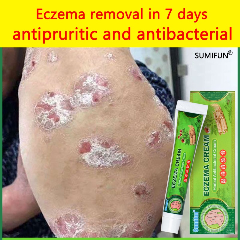 Sumifun Eczema Treatment Cream20g Psoriasis Treatment Cream Anti Itch