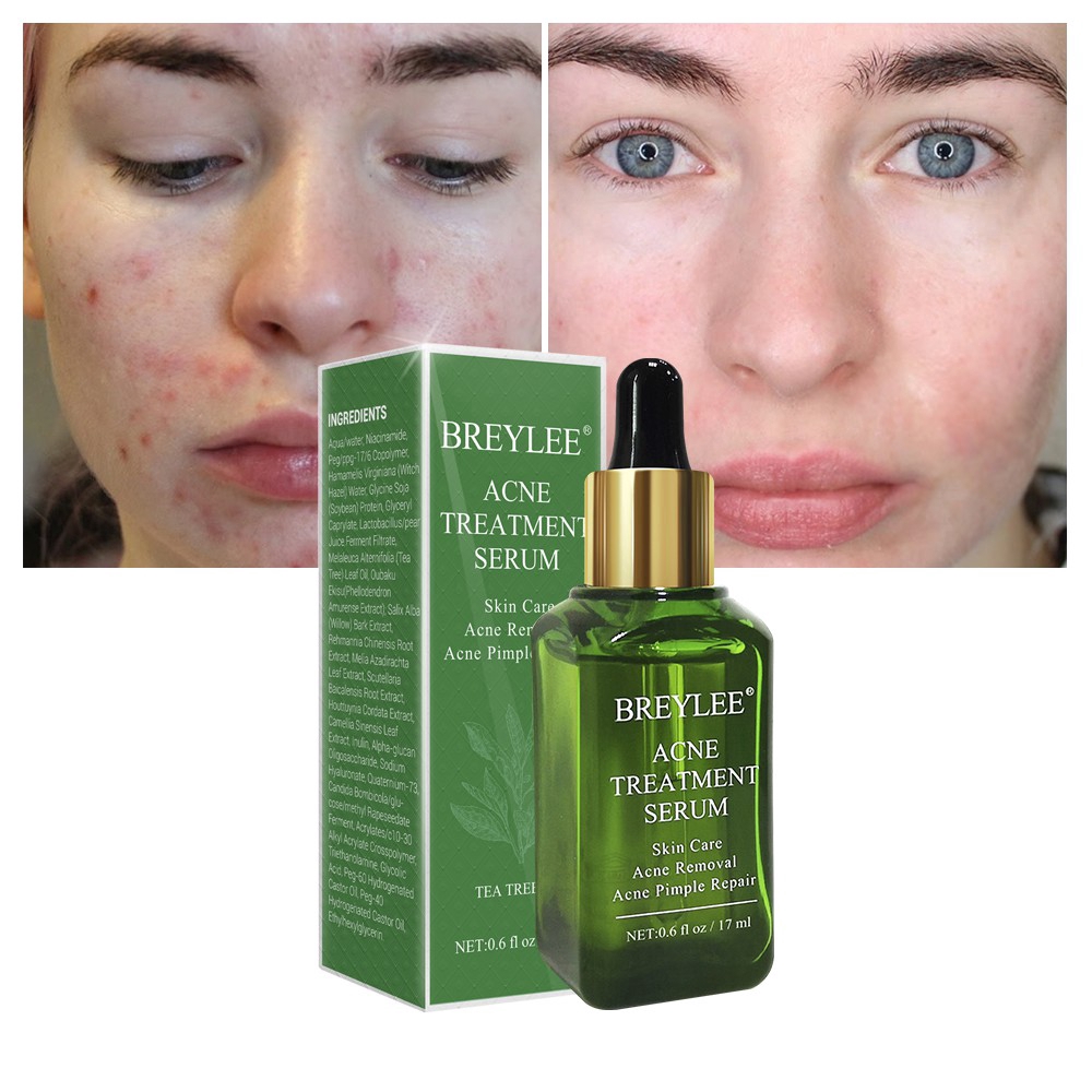 BREYLEE Acne Treatment Serum Anti-Acne Scar Remove Acne Marks Essence