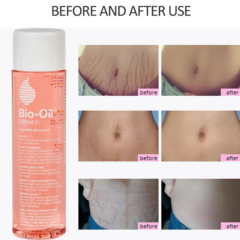 BioOil Skincare for Scar Stretch Mark Treatment Oil Scar Removal Gel