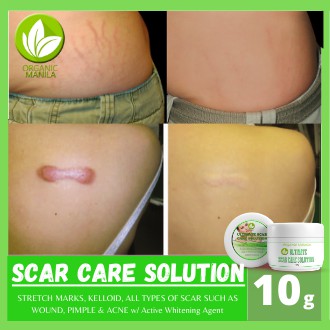 best stretch mark solution