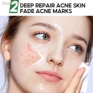 【Factory price】▧∏℡◆VIBRANT GLAMOUR Herbal Acne Treatment Toner Deep Repair Soothing Skin Reduce Pim #6